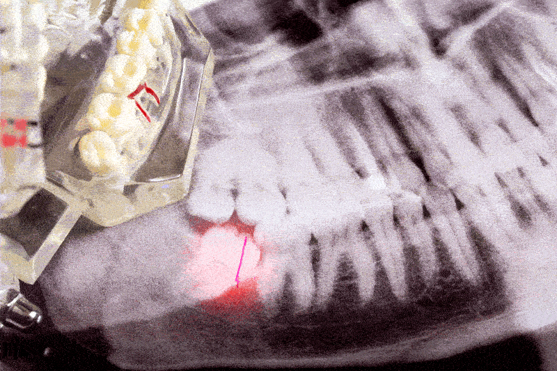 A dental model and X-ray show teeth alignment with a specific focus on a highlighted tooth using a laser pointer. The background is a detailed grayscale dental X-ray.