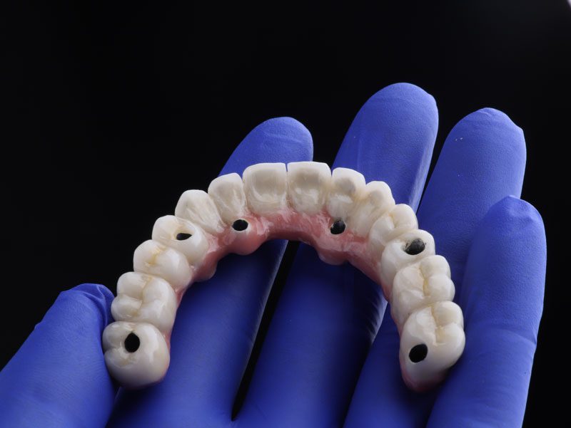 A dental prosthetic with visible screw holes is held by a gloved hand against a dark background.