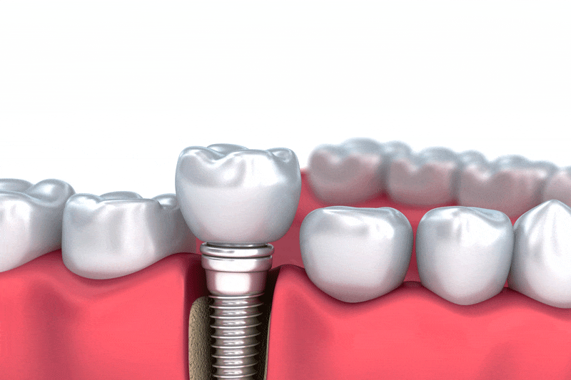 A dental implant integrates with a jawbone cross-section, securing a tooth crown; it’s surrounded by natural white teeth and red gum tissue, demonstrating implant placement in an anatomical context.
