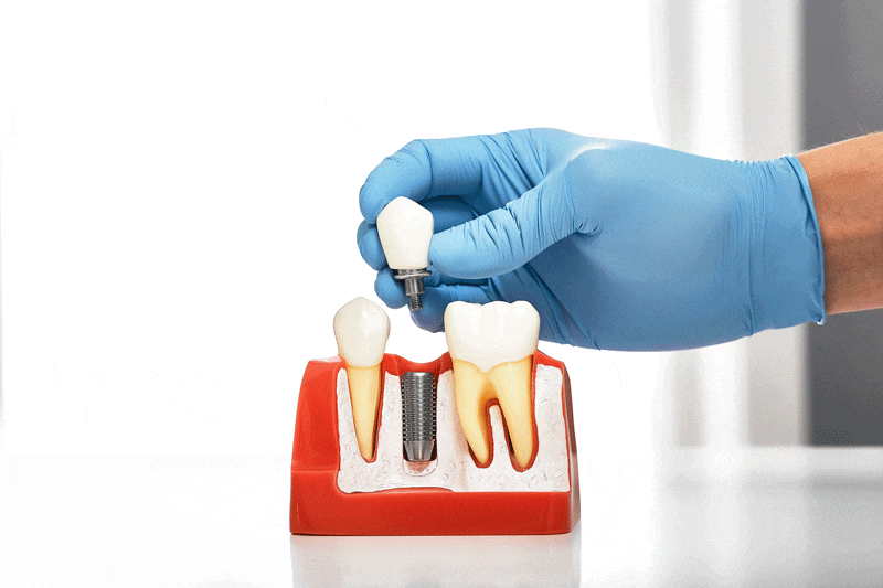 A dental model with teeth shows a blue-gloved hand placing a dental implant into a gum model, set on a reflective surface in a clinical environment.