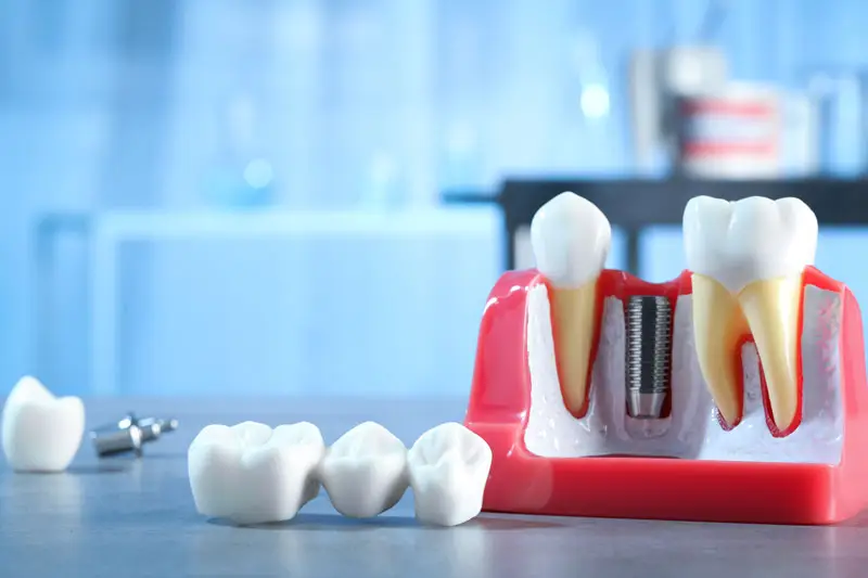Dental model with teeth and implant is displayed on a table, surrounded by additional crowns and tools, in a clinical setting with blurred blue background.