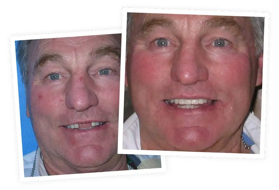 Two side-by-side close-up photos of a man's face; one shows him with missing teeth, the other with restored teeth, highlighting a dental transformation. Backgrounds: blue and neutral tones.