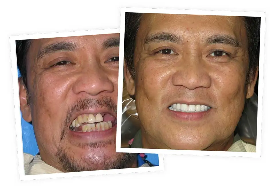 Person smiling, showing teeth in two photos; first with uneven, discolored teeth, second with straight, white teeth. Background is blue and neutral, indicating a dental transformation.