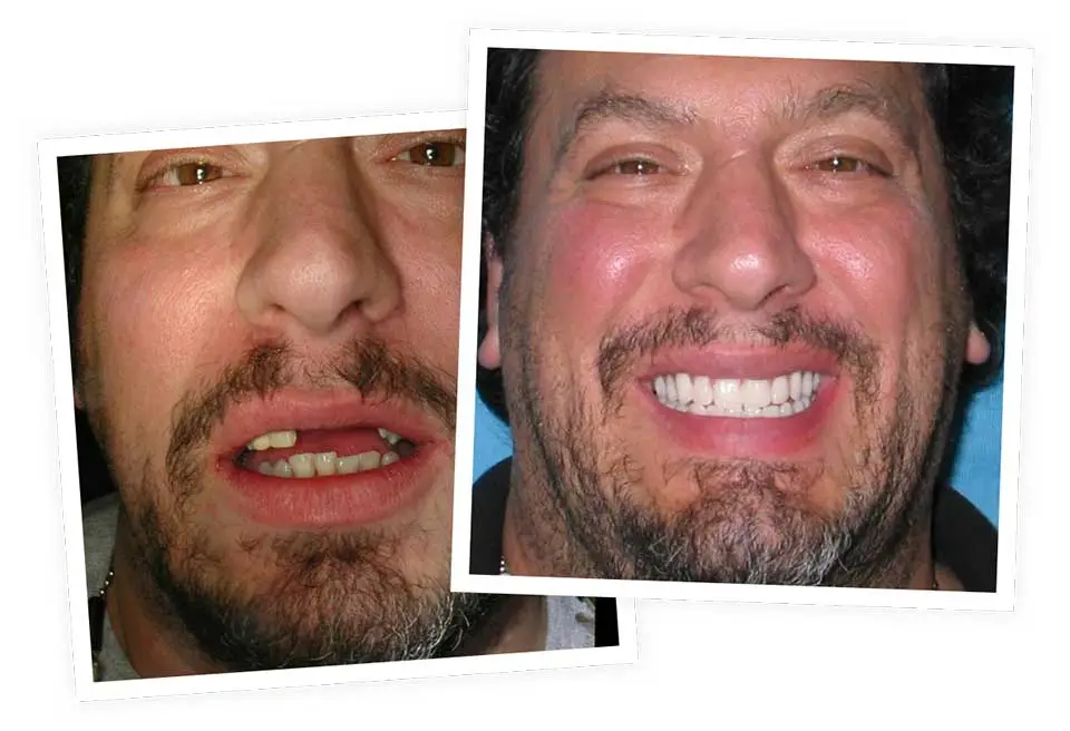 Two photographs show a man before and after dental restoration. The first image reveals missing and misaligned teeth, while the second displays a full set of bright, even teeth against a blue background.