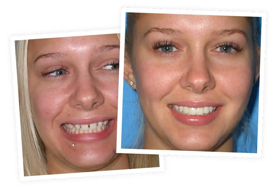 Two overlapping close-up photos of a young woman smiling. The left image shows her with a lip piercing and teeth slightly visible. The right image shows her with a wider smile against a blue background.