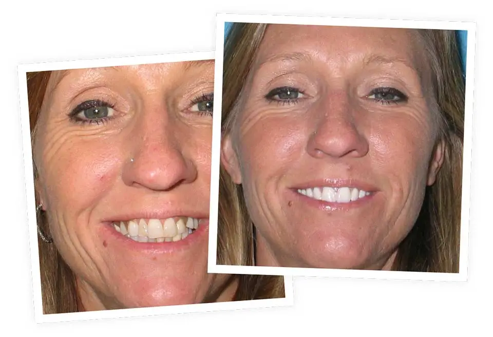 Two close-up photos of a smiling woman, shown side by side. The left image has more visible wrinkles around her eyes compared to the right image, which appears smoother.