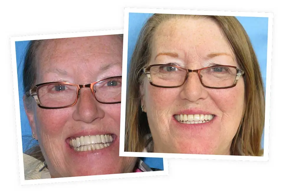 Two overlapping photos show a woman with glasses smiling broadly. The first image captures her with teeth more visibly prominent, while the second showcases a more natural smile. Blue backgrounds.