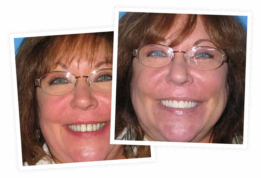 Two overlapping photographs show a smiling woman wearing glasses, highlighting her teeth. She has light brown hair, and the background appears to be a plain blue surface.
