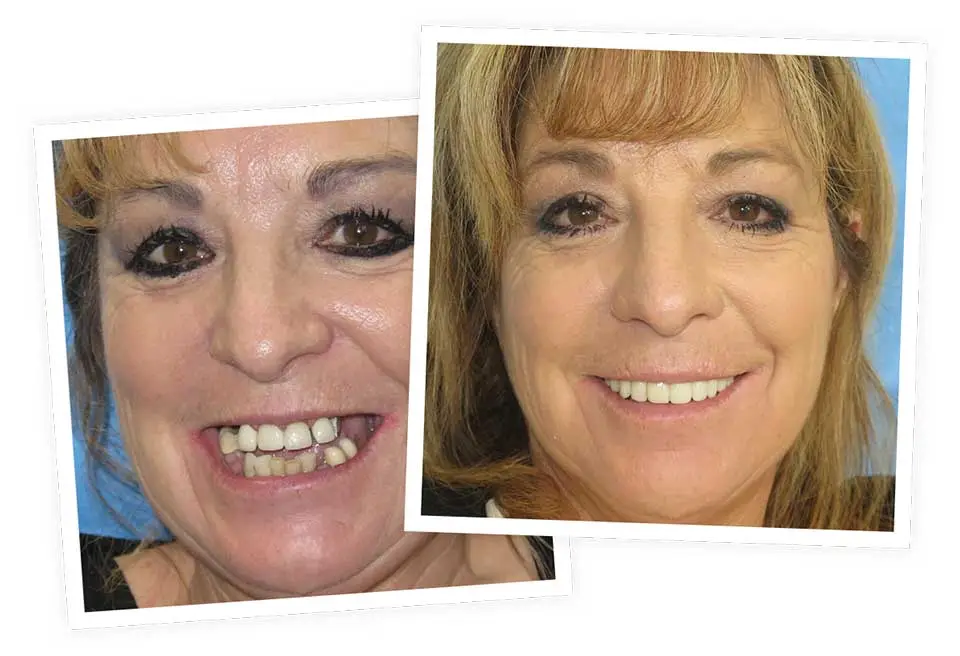 Two side-by-side photos of a woman smiling. The first shows incomplete teeth, while the second displays a complete, bright smile. Both images have a blue background.