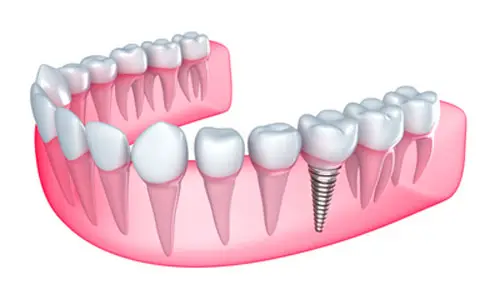 A dental implant is placed in the lower jaw, replacing a missing tooth among natural teeth. The gum tissue and roots are visible, illustrating a cross-sectional view of dental anatomy.