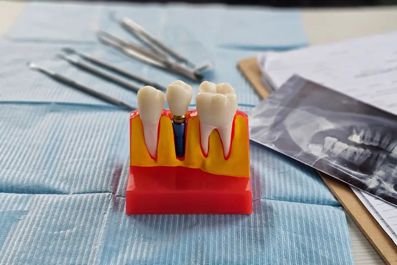 Dental model displaying teeth and implant in cross-section, placed on a blue dental cloth. Surrounding are scattered dental tools and an X-ray image on a clipboard.