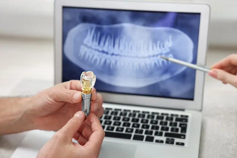 A person holds a dental implant model, while another points to a dental X-ray on a laptop screen, illustrating dental examination and implant procedure.