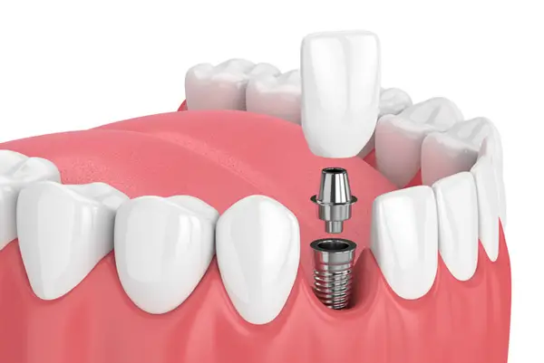 A dental implant is being inserted into gums, surrounded by natural teeth. The implant includes a metal screw and abutment, with a crown ready to be placed.