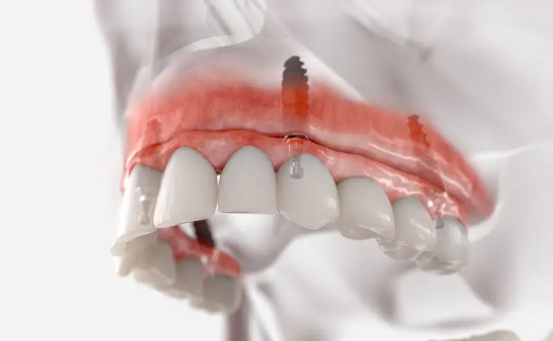 A digital rendering of a dental implant shows screws embedded into upper gums, supporting a row of prosthetic teeth. The transparent perspective highlights the integration within a human skull structure.