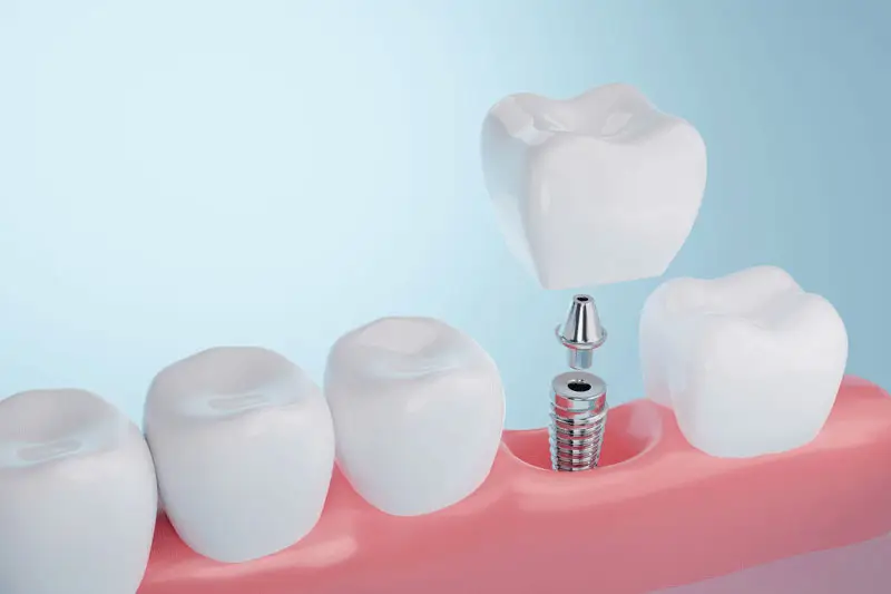 A dental implant procedure is shown, with a metal post anchored in the gum and a porcelain tooth hovering above it, surrounded by natural teeth against a light blue background.