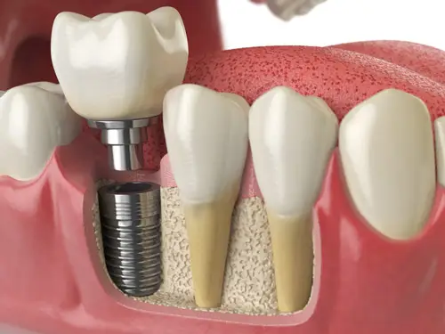 Dental implant integrated into jawbone, showcasing a cross-section view. Adjacent natural teeth roots are visible, with gum tissue and bone structure surrounding the metallic implant supporting a prosthetic tooth.