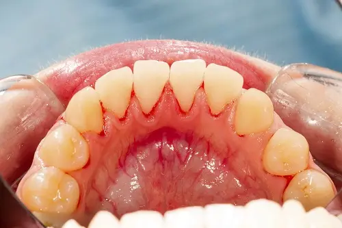 A set of human upper teeth is shown with gums and enamel highlighted. The image is taken inside a dental office, using cheek retractors to provide a clear view.