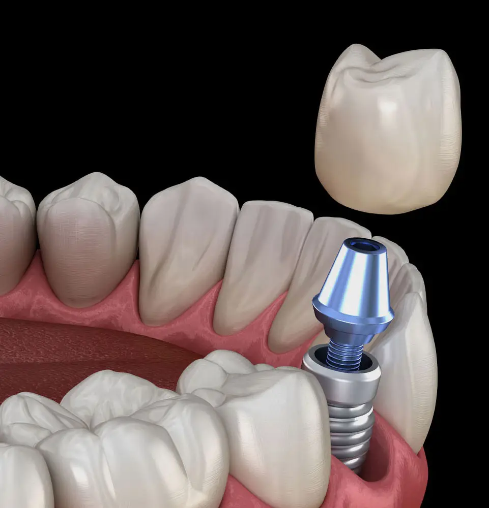 A dental implant and crown are being positioned in a lower jaw. The metal implant is anchored in the gum, while the tooth-shaped crown hovers above, set against a black background.