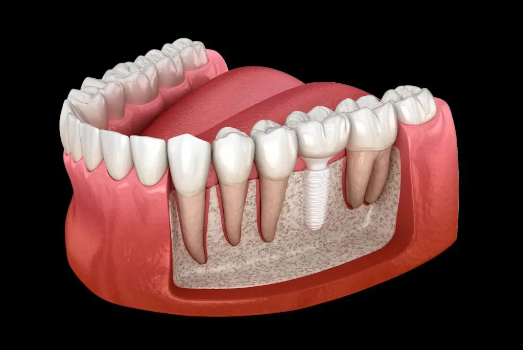 A dental illustration shows a cross-section of a human mouth featuring an implanted artificial tooth. The implant is integrated into the jawbone, with surrounding teeth and tissue visible.
