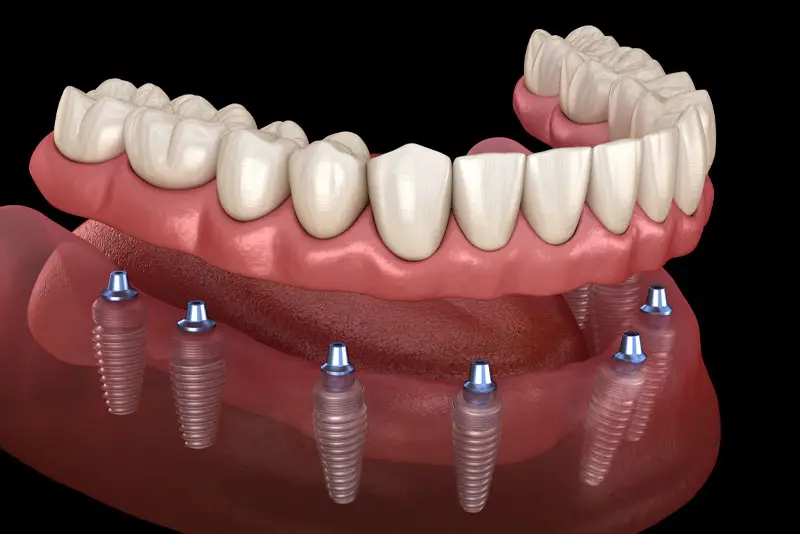 A set of dental implants, consisting of six titanium screws, supports a model of an upper arch denture. The dentures and gums are presented against a black background for clarity.