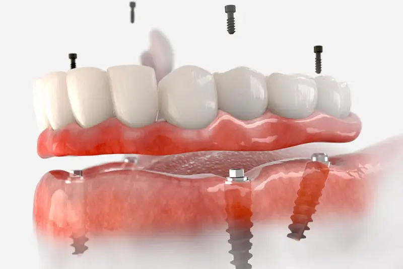 Dental implants are shown being aligned with a lower jaw; artificial teeth hover above the gums, with visible screws indicated for attachment, illustrating the dental implant process in a medical context.