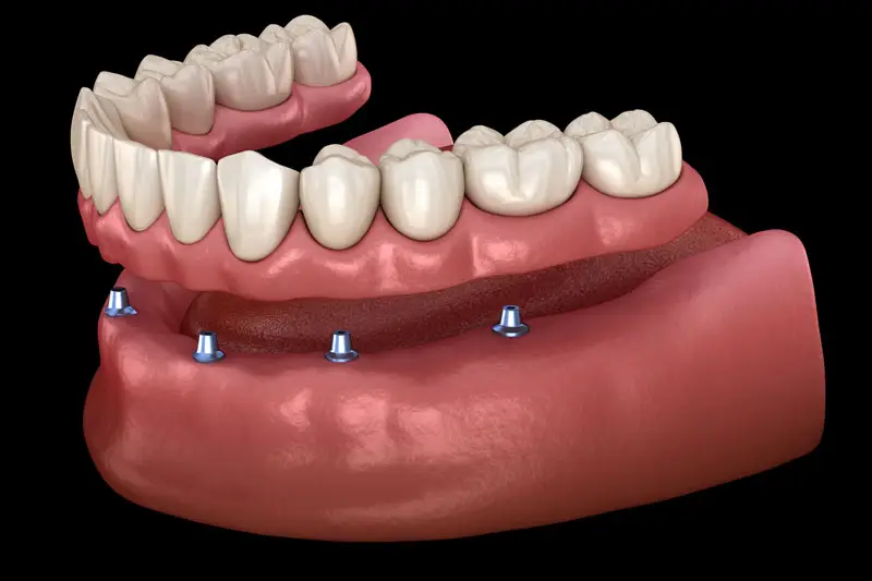 A dental model shows an upper denture aligned above a lower gum with four dental implant posts. The context is a black background, highlighting the dental apparatus.