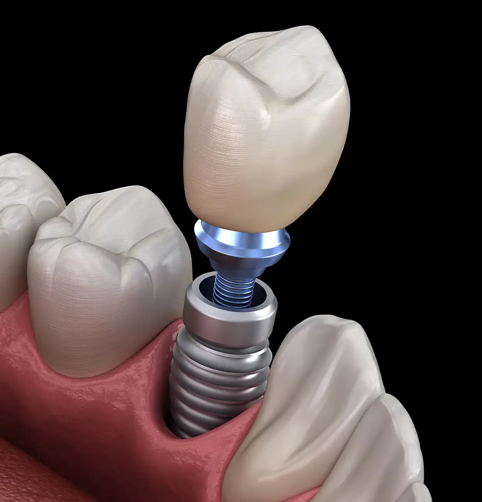 implant model 3d