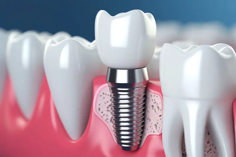 A dental implant with a metal screw is integrated into a jawbone, replacing a missing tooth. It's flanked by natural teeth, illustrating oral health restoration in a clinical context.
