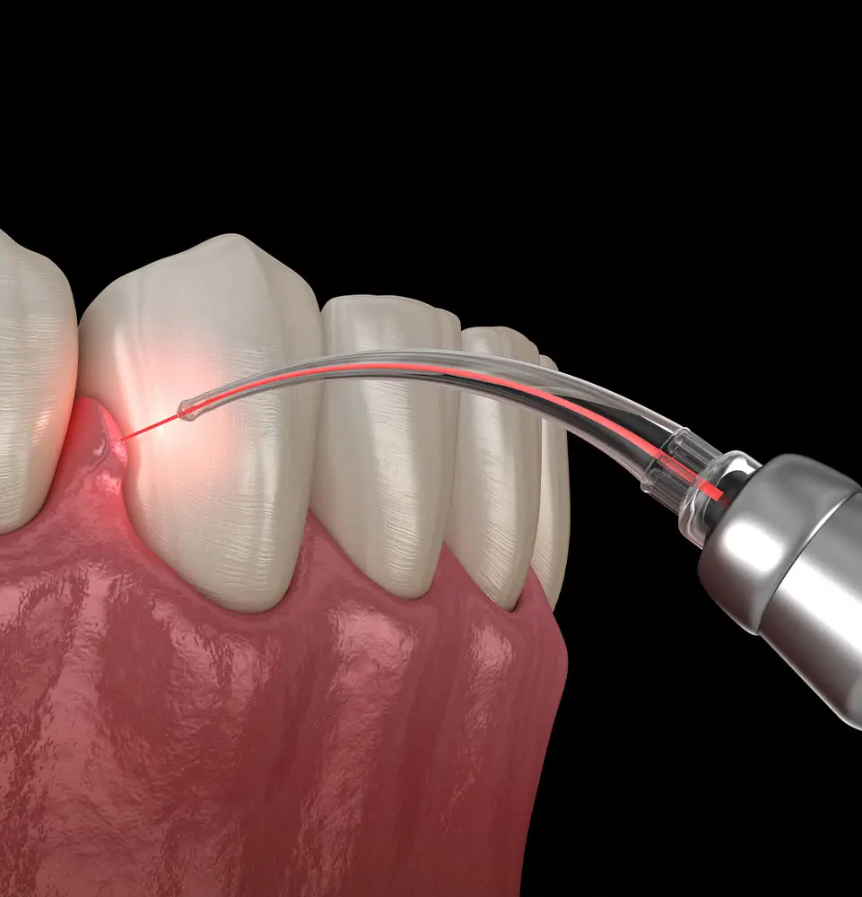 A dental laser is targeting the gum line near teeth, emitting a red light in a clinical setting with a black background.