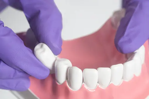 A dental model shows white teeth being held by purple-gloved hands, set against a pink gum-like base on a light surface.