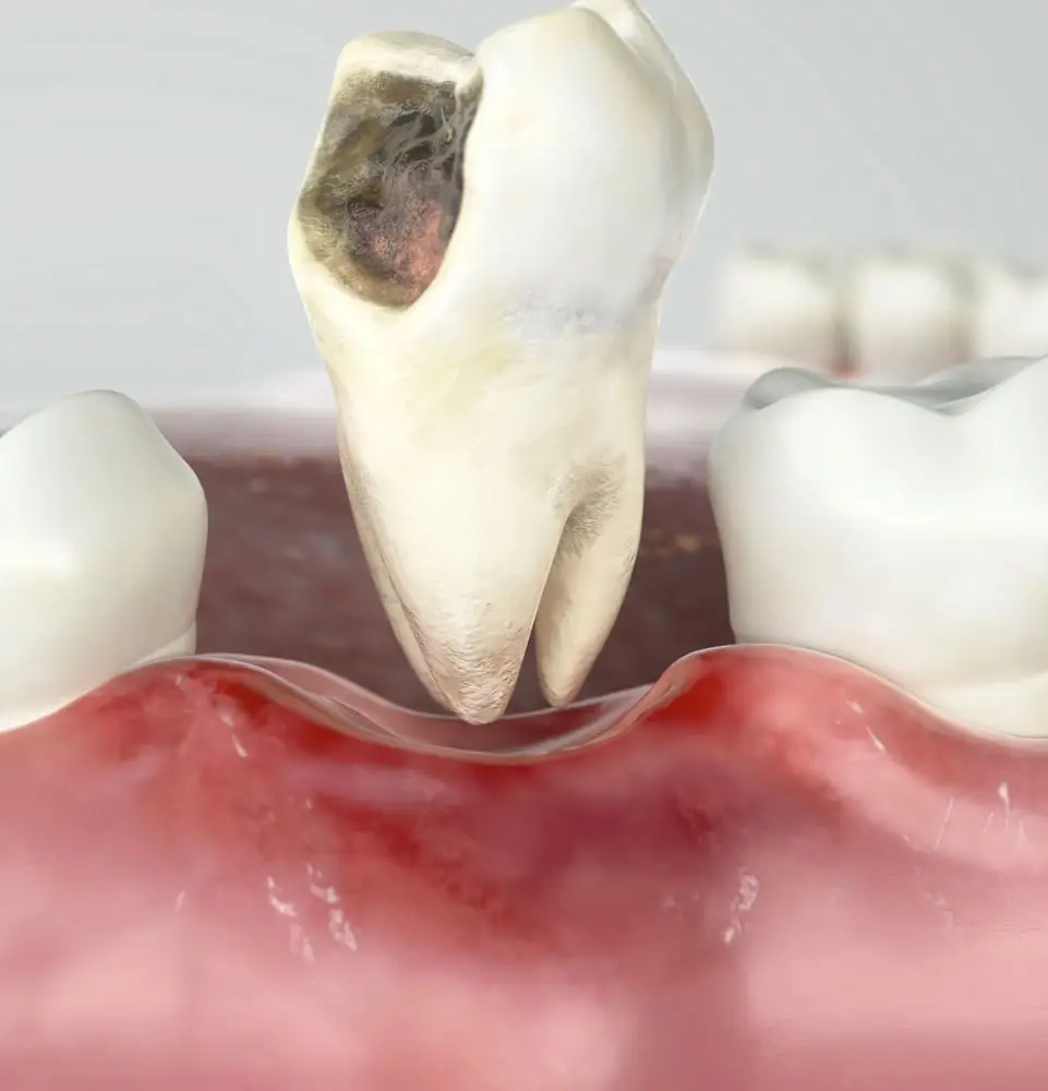 tooth extration model 3d