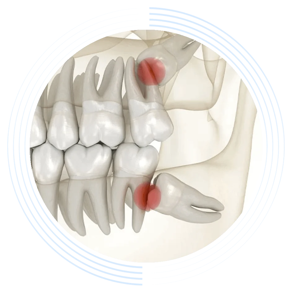 Molars pushing against partially erupted wisdom teeth, highlighted with red circles, in a diagrammatic representation of the lower jaw. Concentric blue patterns frame the image.