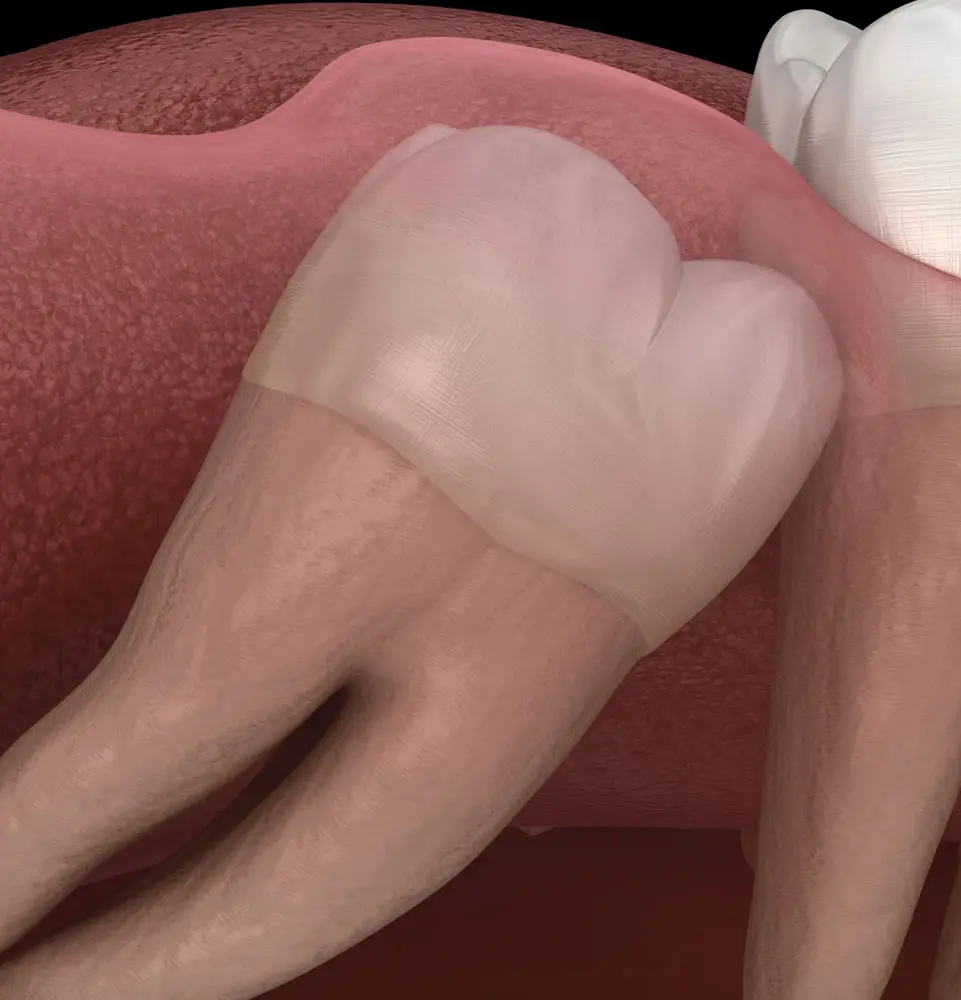 wisdom tooth 3d model